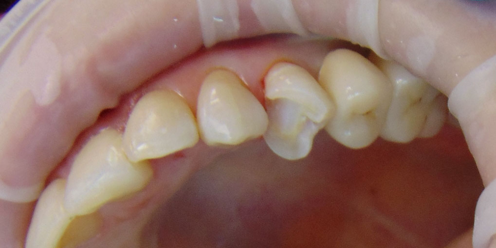  Восстановление зуба с помощью керамической вкладки
