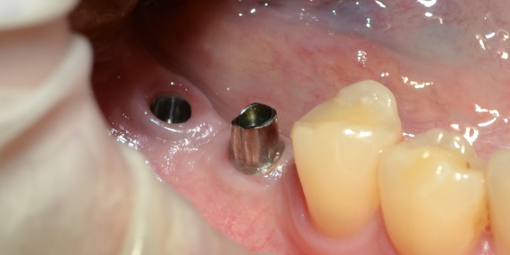  Пациентке было установленно 2 имплантата в области 45, 46 зубов