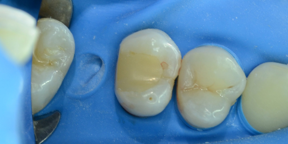  Художественная реставрация жевательного зуба материалом Charisma