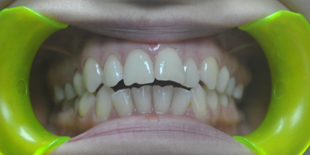  Ортодонтическое лечение с применением многопетлевой дуги, металлических самолигирующихся брекетов