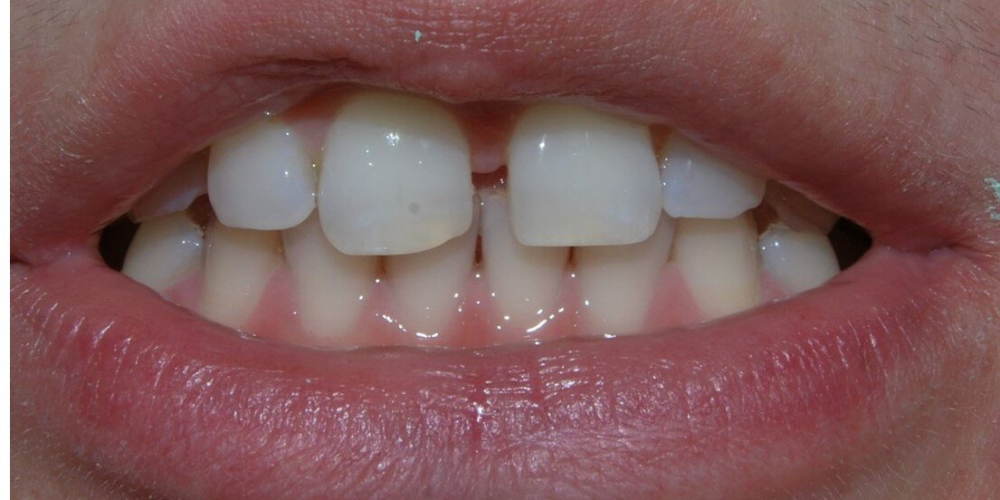  Убрали диастему между передними зубам верхней челюсти, до и после