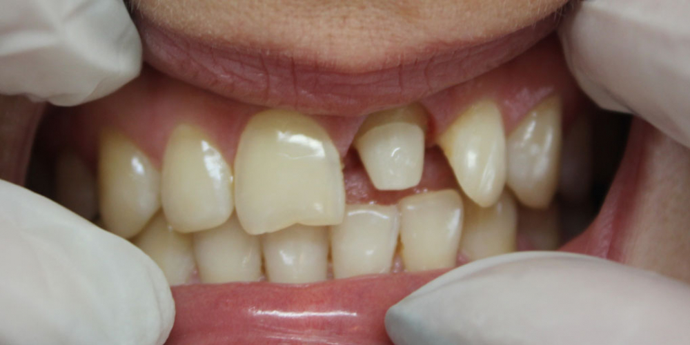  Восстановление центрального зуба  диоксид циркониевой коронкой