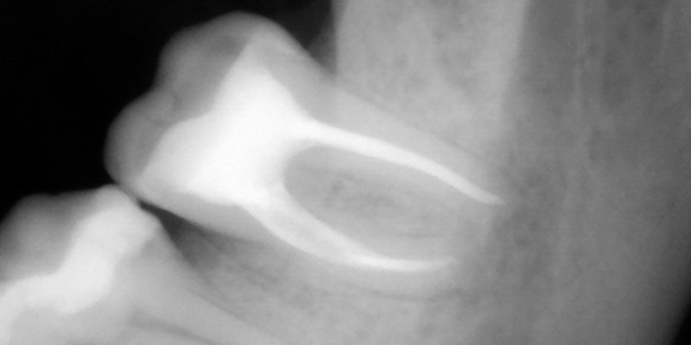  Пломбировка каналов гуттаперчей с последующей реставрацией коронки зуба