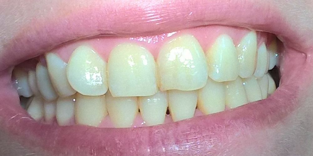  Результат отбеливания зубов по системе Amazing White