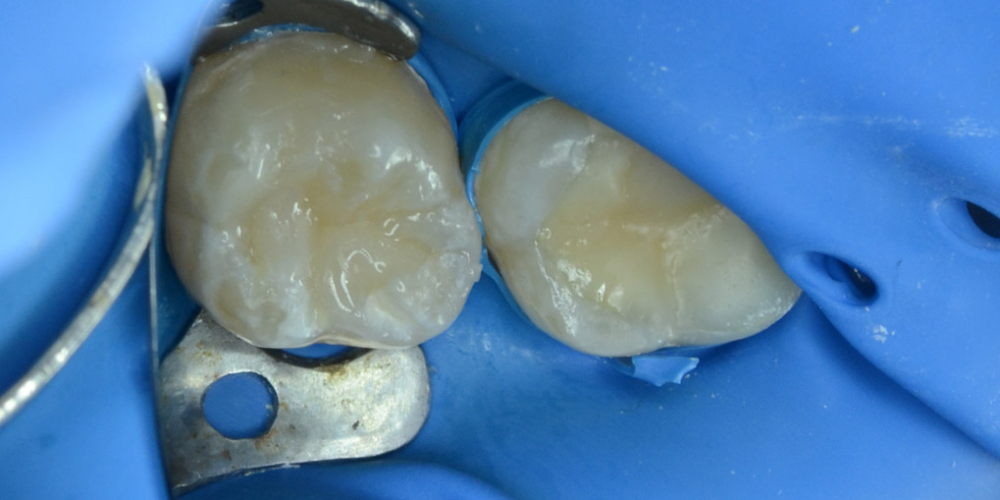  Лечение кариеса с последующей реставрацией анатомической формы зуба
