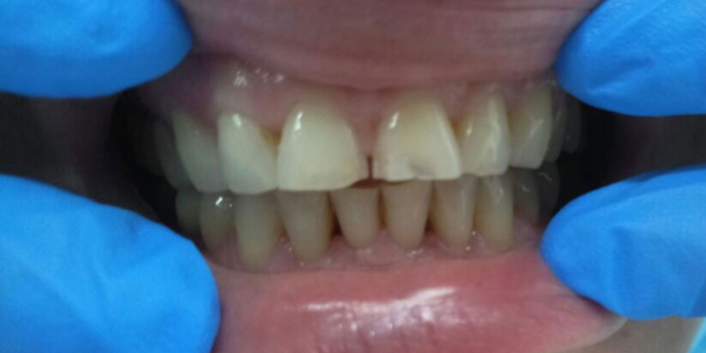  Результат реставрации центральных зубов