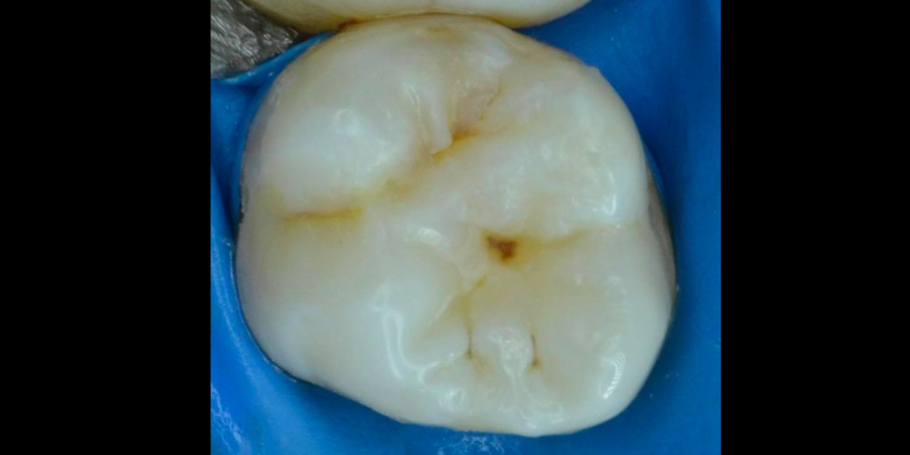  Лечение кариеса 26 зуба с использованием стоматологического микроскопа