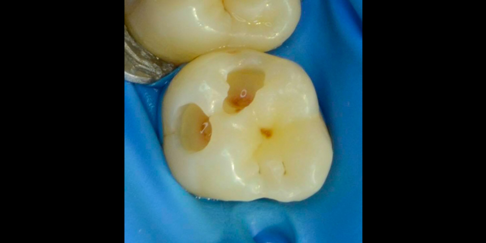  Лечение кариеса 26 зуба с использованием стоматологического микроскопа