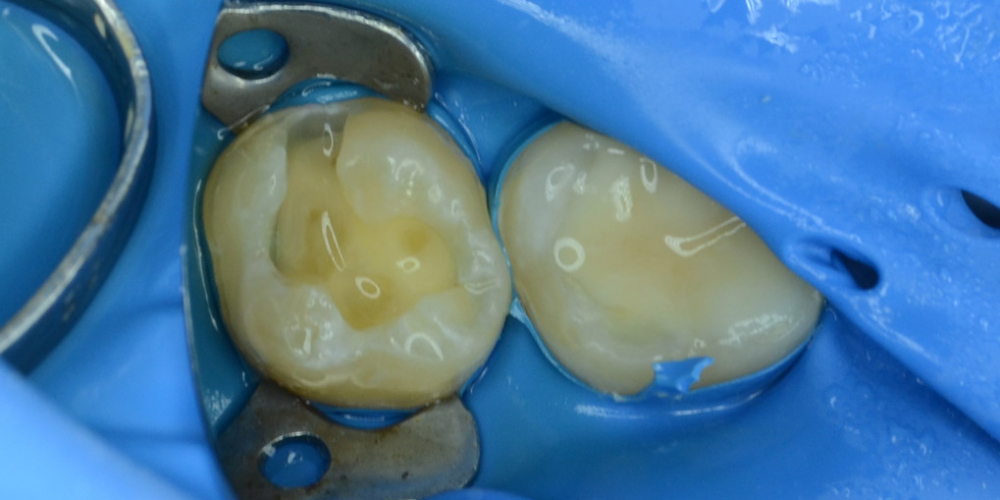  Лечение кариеса с последующей реставрацией анатомической формы зуба