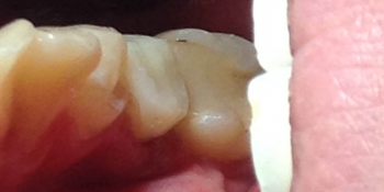 Задача восстановить разрушенную коронку зуба фото после лечения