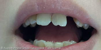 Адгезивный мост на передние зубы фото до лечения