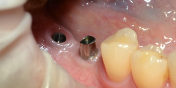 Пациентке было установленно 2 имплантата в области 45, 46 зубов фото до лечения