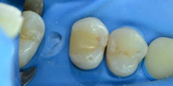 Художественная реставрация жевательного зуба материалом Charisma фото до лечения