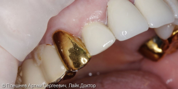 Восстановление 12 зуба коронкой фото после лечения