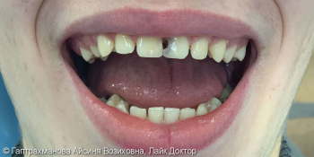 Реставрация центральных зубов верхней челюсти фото до лечения