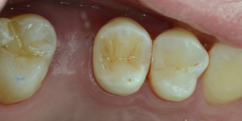 Художественная реставрация жевательного зуба материалом Charisma фото после лечения