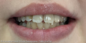 Адгезивный мост на передние зубы фото после лечения