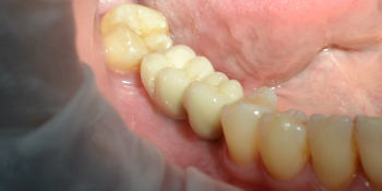 Пациентке было установленно 2 имплантата в области 45, 46 зубов фото после лечения