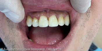 Реставрация центральных зубов верхней челюсти фото после лечения