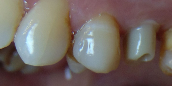 Восстановление зуба с помощью керамической вкладки фото после лечения